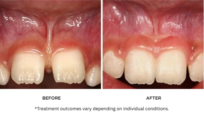 frenectomy before after